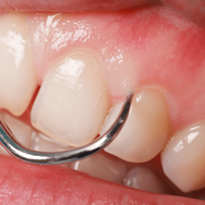 Diş Eti Hastalıkları | Periodontoloji Diş Eti Hastalıkları | Periodontoloji